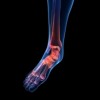 Gout - Ankle & Foot